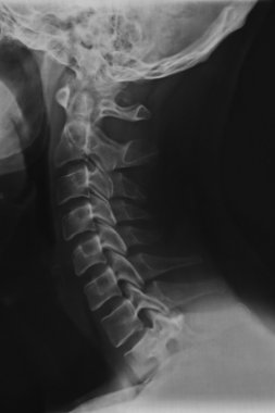 boyun ve ense x-ray tarama