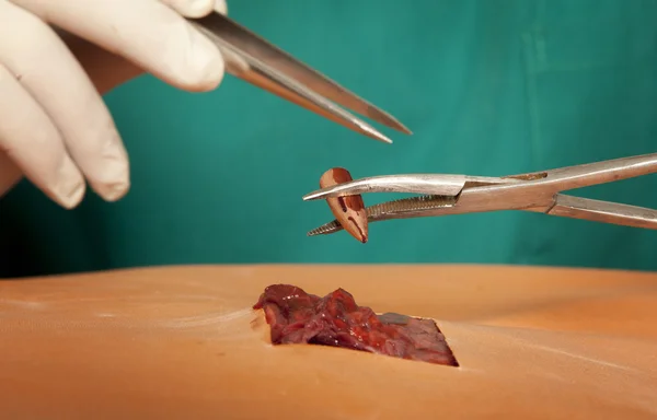 Chirurg hält blutige Kugel in der Hand — Stockfoto