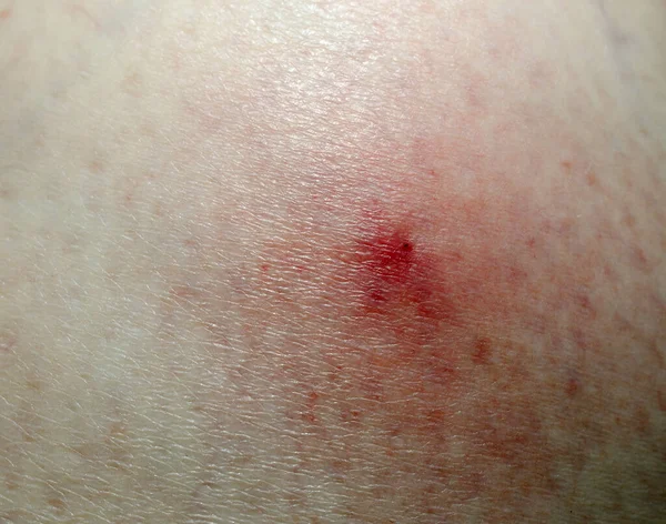 redness and tick bite marks on the skin