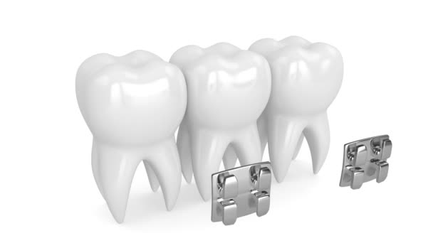 Dents Avec Appareils Orthodontiques Dentaires — Video