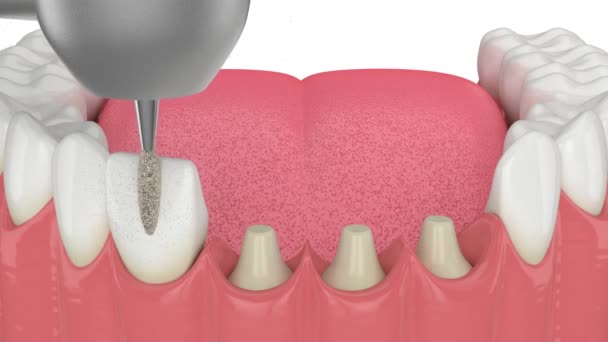Szczęka Koronami Dentystycznymi Osadzona Zmienionych Zębach Białym Tle — Wideo stockowe