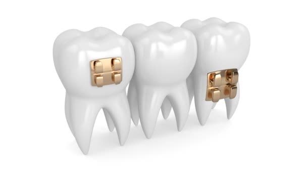 Zuby Zlatými Ortodontickými Rovnátky — Stock video