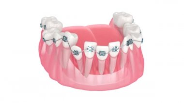 Beyaz arkaplan üzerinde izole edilmiş ortodontik diş telleri ile hizalama