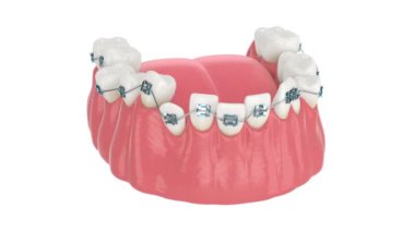 Beyaz arkaplan üzerinde izole edilmiş ortodontik diş telleri ile hizalama