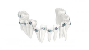 Beyaz arkaplan üzerinde izole edilmiş ortodontik diş telleri ile hizalama