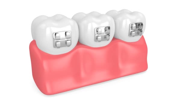 Зубы Ортодонтическими Брекетами — стоковое видео