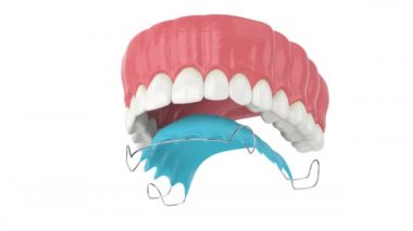 Ortodontik çıkarılabilir diş koruyuculu üst çene
