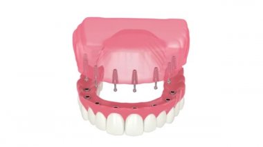 Çıkarılabilir tam implant takma diş kurulumu