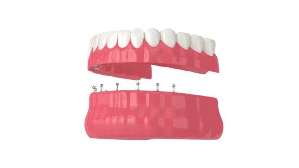 Removable Snap Full Implant Denture Installation — Stock Video