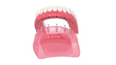 Çıkarılabilir tam implant takma diş kurulumu