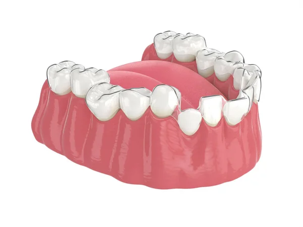 Render Jaw Clear Aligner Splint White Background — Stock Photo, Image