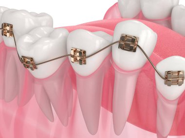 3D diş düzeltme beyaz üzerine ortodontik diş telleri ile hizalama 