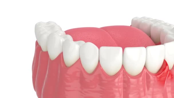 Láser Diodo Dental Utilizado Para Tratar Las Encías Concepto Utilizar — Vídeos de Stock