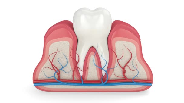 Dente Com Tártaro Gengivas Sangrantes — Vídeo de Stock