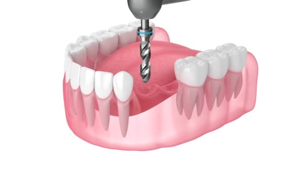 Kæbe Med Implantat Understøttet Dental Cantilever Bro Procedure Isoleret Hvid – Stock-video