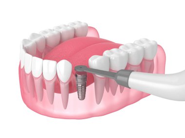 Gömülü şifa kapağı ve beyaz arkaplan üzerinde akıllı implant dedektörü ile 3D çene oluşturma