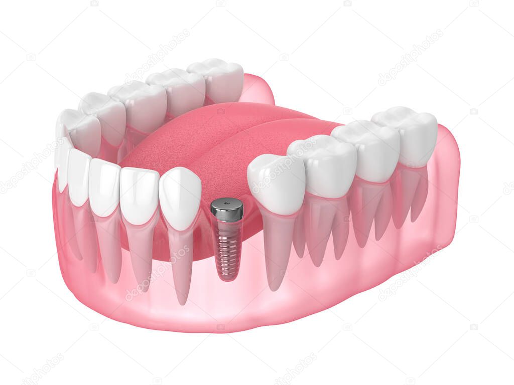 3d render of jaw with implant screw and healing cap over white background. Dental implantation concept