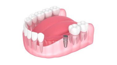 Akıllı implant dedektörlü çene beyaz arkaplan üzerinde gömülü şifa kapağı bulmaya yardımcı olur