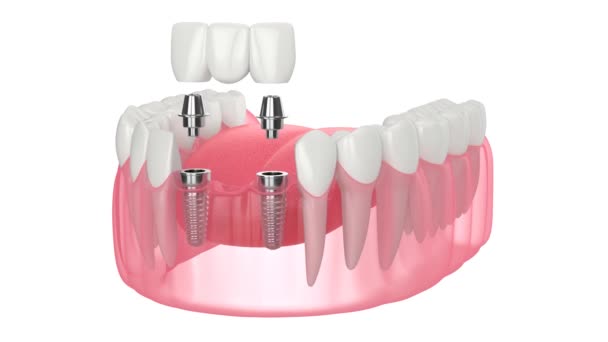 Kaken Met Implantaten Ondersteunen Tandheelkundige Brug Witte Achtergrond — Stockvideo