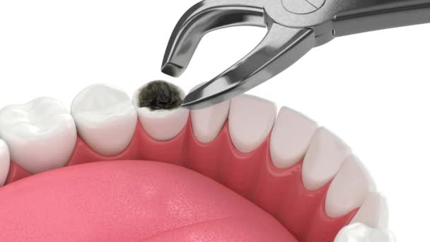 Extracción Dental Instalación Implantes Dentales — Vídeos de Stock