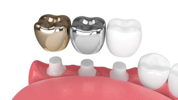 Teeth Jaw Three Different Types Dental Crown Filling — Stock Video