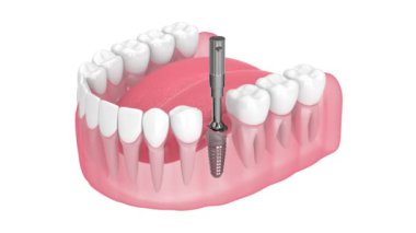 Kemik entegrasyonu izleme cihazı ile diş implantı stabilitesi kontrol ediliyor
