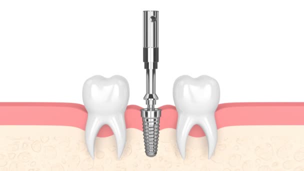 Comprobación Estabilidad Del Implante Dental Mediante Dispositivo Monitoreo Oseointegración — Vídeo de stock
