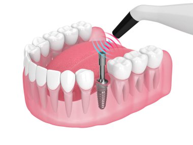Kemik entegrasyonu izleme cihazı ile diş implantı stabilitesi kontrol ediliyor