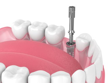 İmplant istikrarını kontrol etmek için çoklu pedallı 3D diş implantı