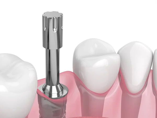 Renderizado Implante Dental Con Multiclavija Para Comprobar Estabilidad Del Implante — Foto de Stock