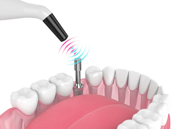 Comprobación Estabilidad Del Implante Dental Mediante Dispositivo Monitoreo Oseointegración —  Fotos de Stock