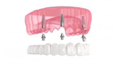 Alt çene protezi hepsi implantlar tarafından desteklenen 4Sistemde