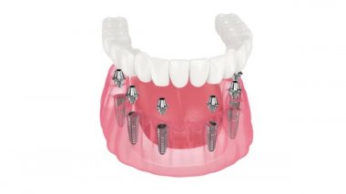 Mandibular prosthesis all on 6 system supported by implants