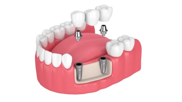 Mandíbula Con Implantes Que Soportan Puente Dental Sobre Fondo Blanco — Vídeos de Stock