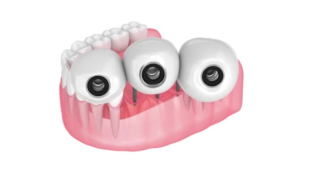 白い背景にミニ歯科インプラントでサポートされている歯科ブリッジ — ストック動画