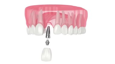 Beyaz arkaplan üzerinde diş implant kurulumu ile üst çene