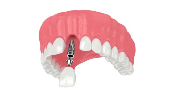 Mandíbula Superior Con Instalación Implante Dental Sobre Fondo Blanco — Vídeos de Stock