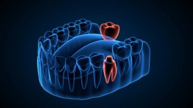 Diş köprüsünü destekleyen implantlı çene koyu mavi arkaplan üzerinde x-ray etkisi