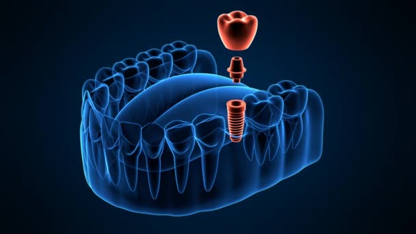 Fogászati Implantátum Elhelyezése Sötétkék Alapon — Stock videók