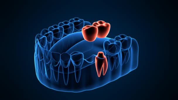 Mandíbula Com Colocação Ponte Cantilever Dental Sobre Fundo Azul Escuro — Vídeo de Stock