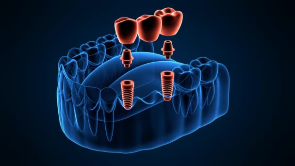 Kiefer Mit Implantaten Die Zahnbrücke Stützen Mit Röntgeneffekt Über Dunkelblauem — Stockvideo