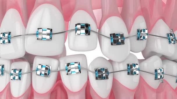 Tänder Uppriktning Ortodontiska Hängslen Isolerade Över Vit Bakgrund — Stockvideo