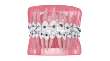 Beyaz arkaplan üzerinde izole edilmiş ortodontik diş telleri ile hizalama