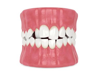 Beyaz arkaplan üzerinde anormal dişleme ile 3d çene oluşturma
