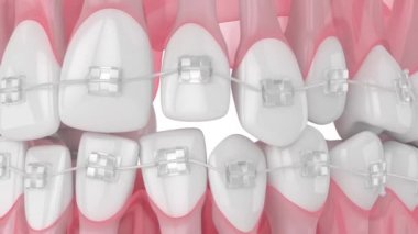 Beyaz arkaplan üzerinde izole edilmiş ortodontik seramik askılar ile diş hizalaması