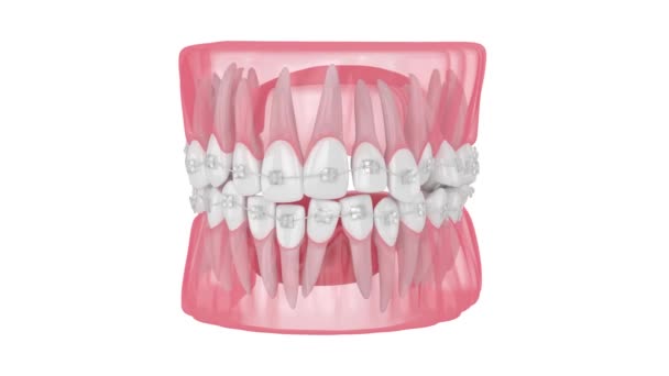 Allineamento Dei Denti Con Bretelle Ortodontiche Ceramica Trasparente Isolate Sfondo — Video Stock