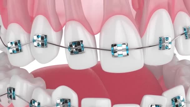歯のアラインメントは 白い背景に隔離された歯の金属製のブレースによって — ストック動画