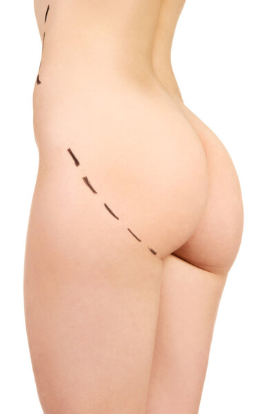 Plastic surgery, buttocks correction.