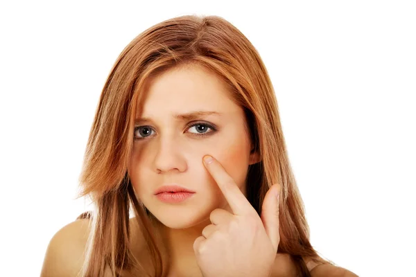 Teenage woman pointing on pimple on her cheek — Stock Photo, Image