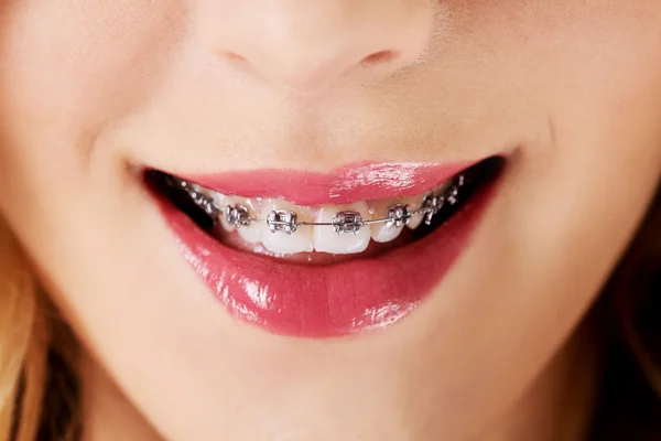 Close up open mouth with braces on teeth. — Stock Photo, Image